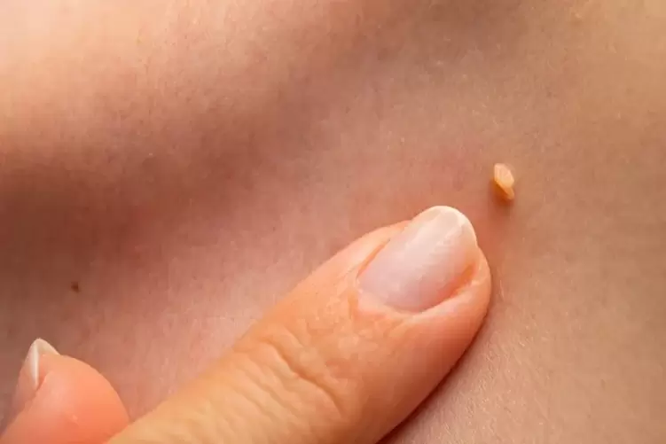 Nipples on the skin