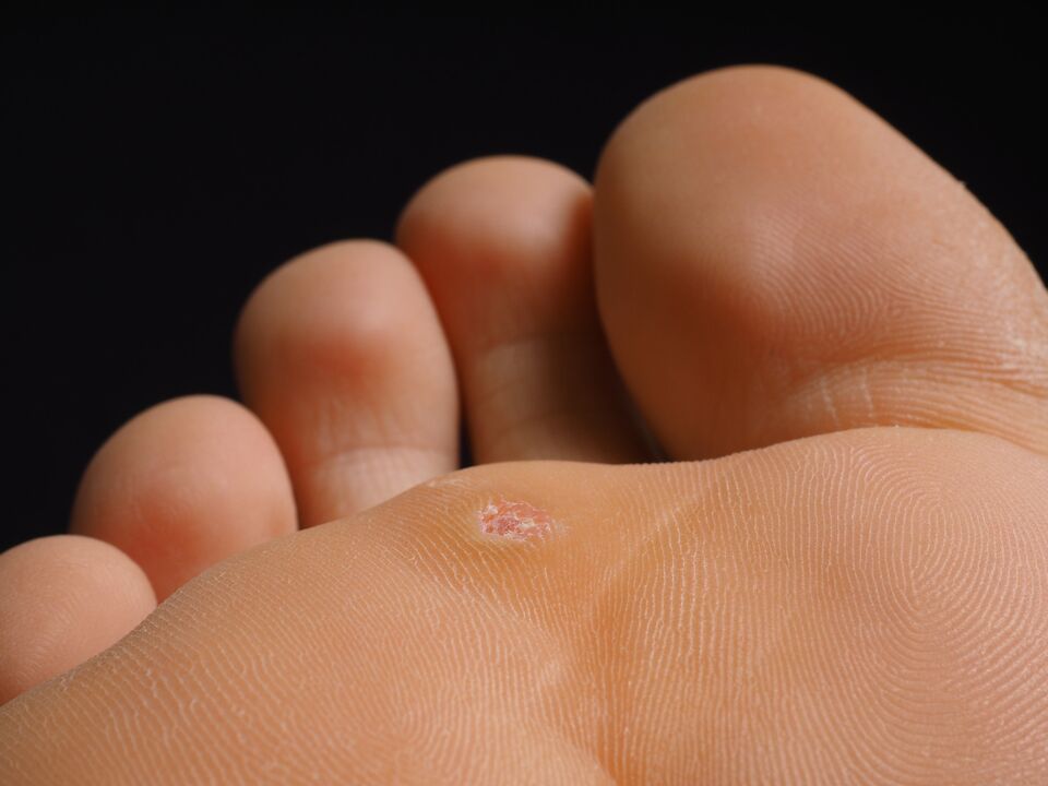 how does it look like plantar warts