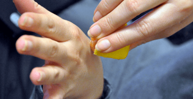 wart removal on the hand