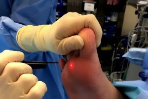 surgical methods for wart removal