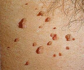 Human papillomavirus in the skin