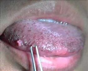 human papillomavirus in the tongue