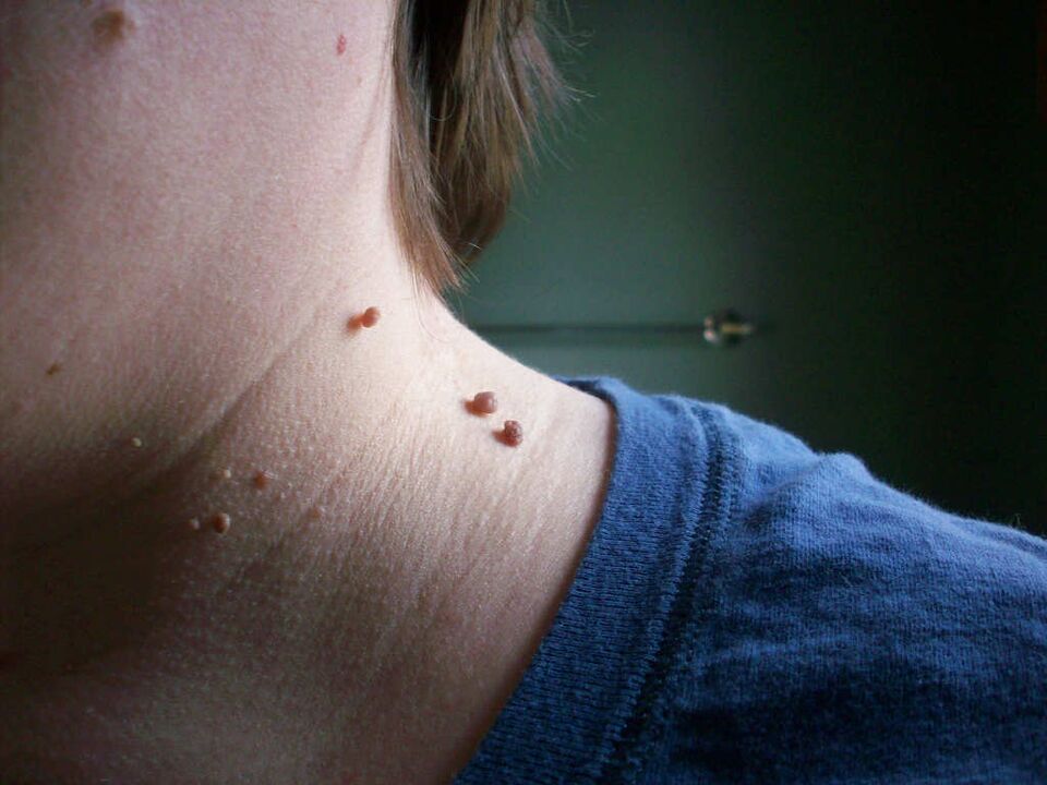 papillomas on the neck how to cure
