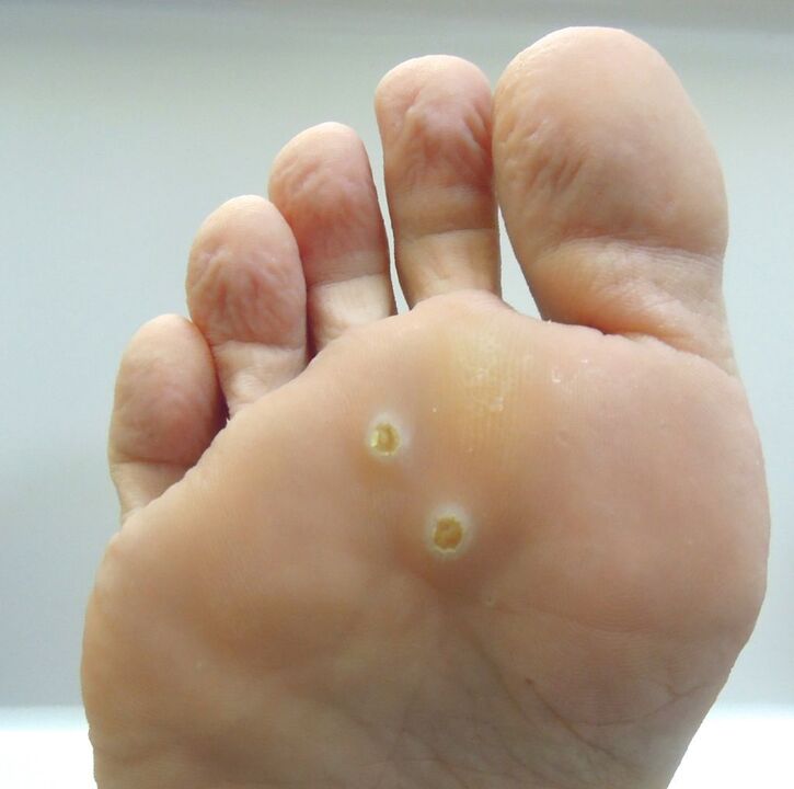 how to get rid of foot warts